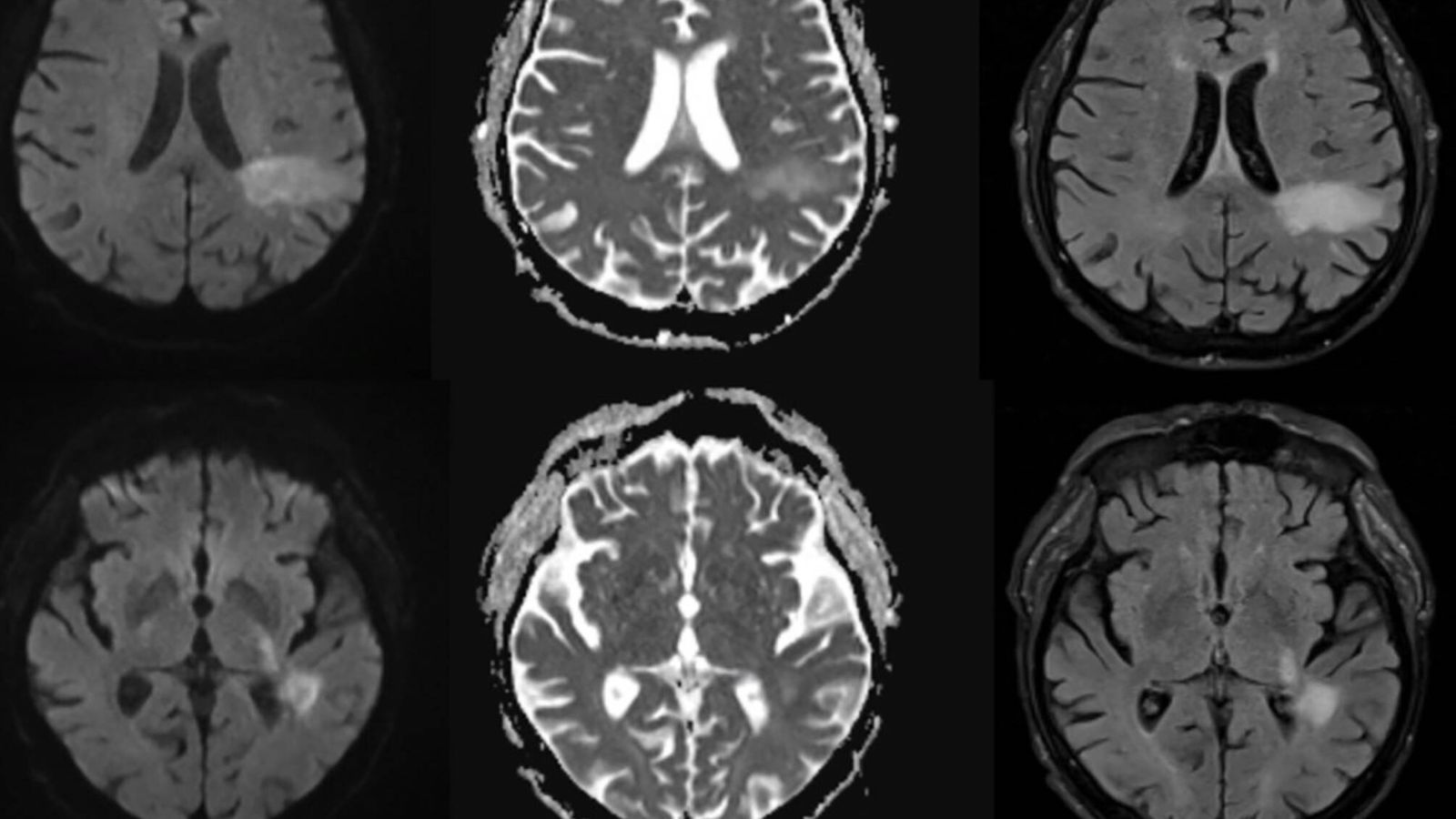 Virus JC: El 'Virus Cerebrum' Silencioso que Podría Afectar al 90% de la Población Virus JC: El 'Virus Cerebrum' Silencioso que Podría Afectar al 90% de la Población