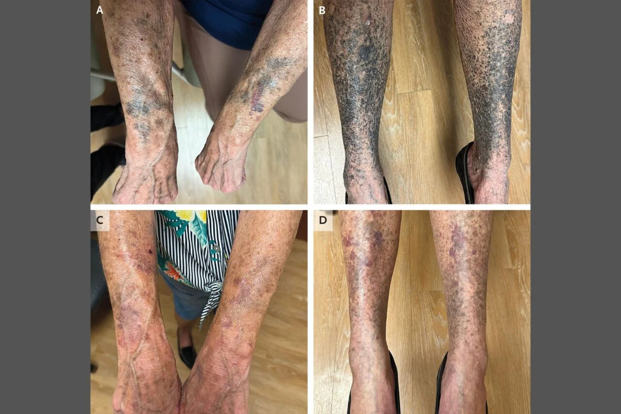 antibiótico minociclina deja extremidades negras por hiperpigmentación en mujer con rosácea antibiótico minociclina deja extremidades negras por hiperpigmentación en mujer con rosácea