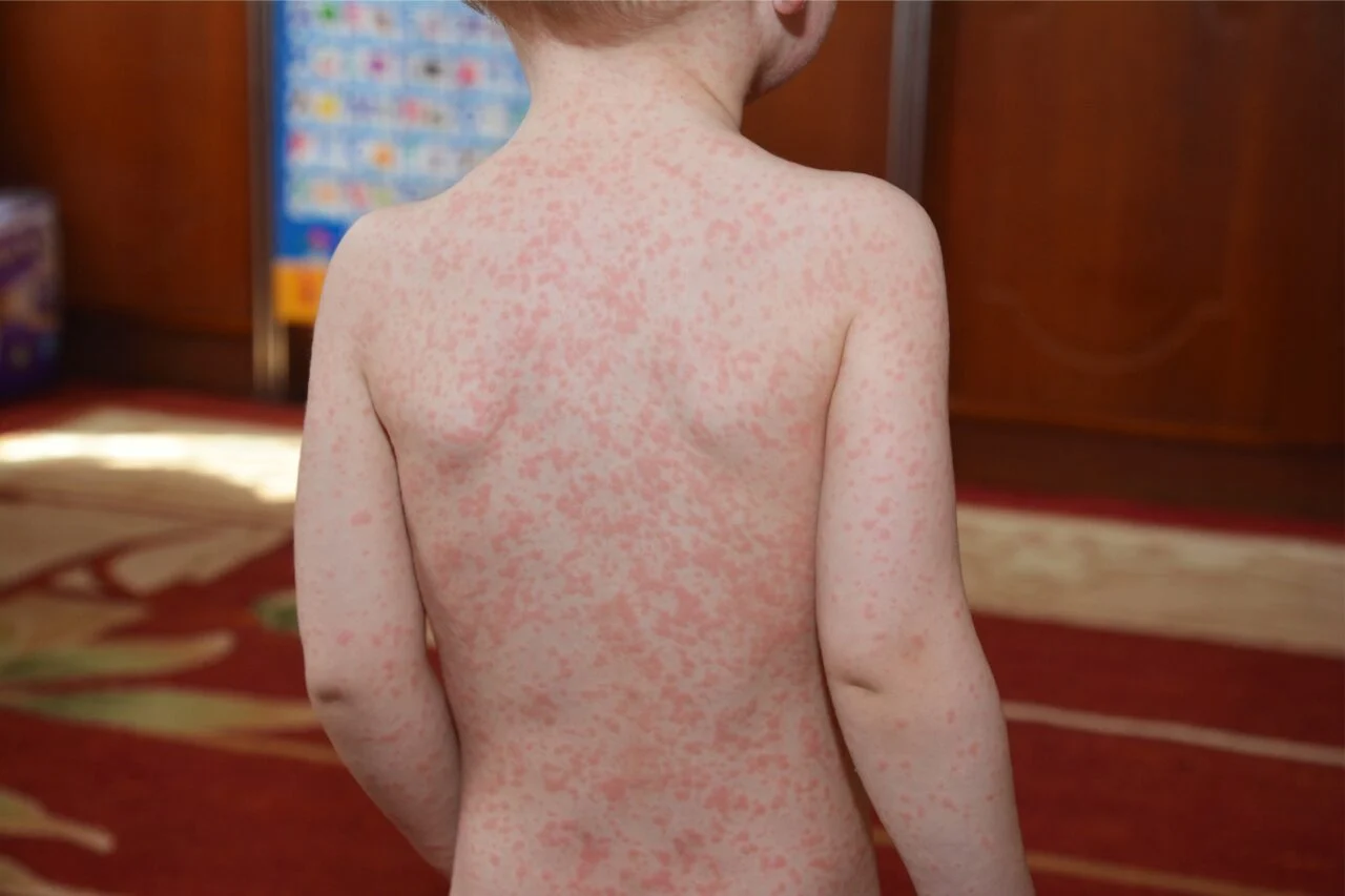 La mononucleosis puede tener un segundo acto preocupante La mononucleosis puede tener un segundo acto preocupante